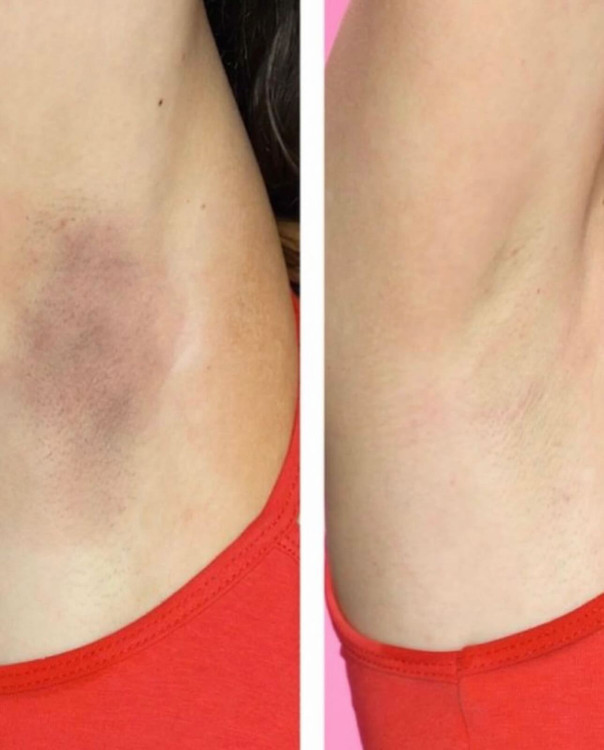 رفع تیرگی بدن