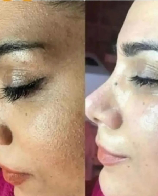 رفع کدری لک تیرگی