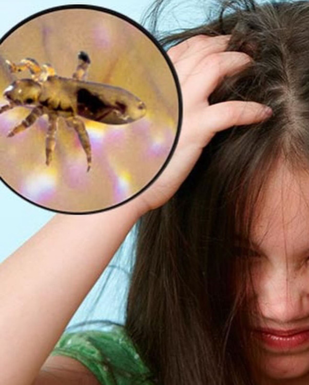 شپش سر کودک