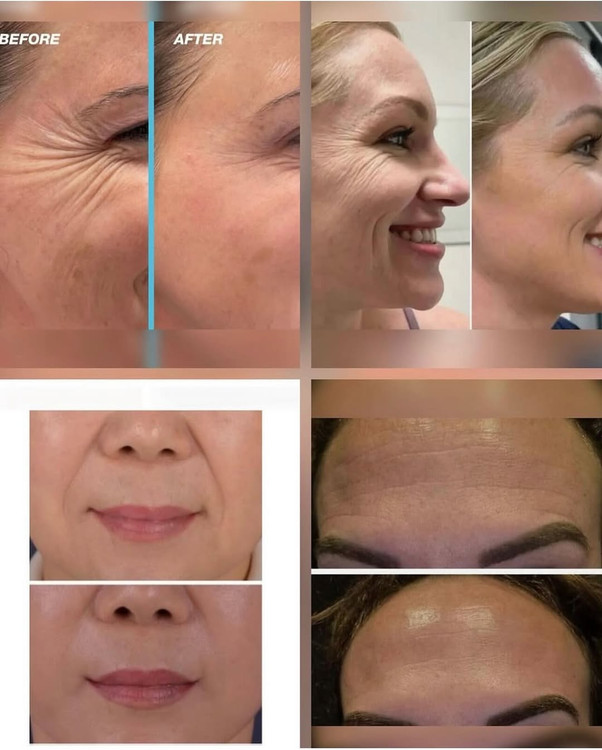 رفع خط اخم رفغ چروک پیشانی رفع