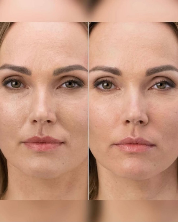 بوتاکس طبیعی