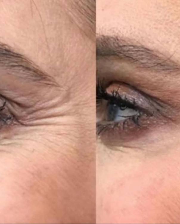 رفع چروک پنجه کلاغی